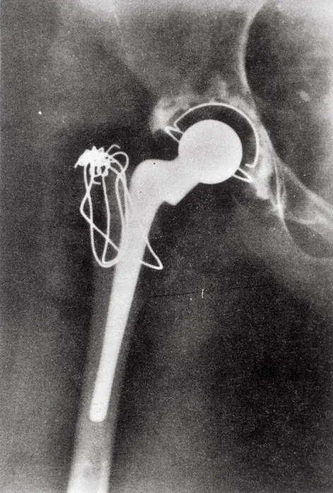 Framed Print : X-ray Hip Joint Replacement Print Framed Print : X-ray Hip Joint Replacement Print