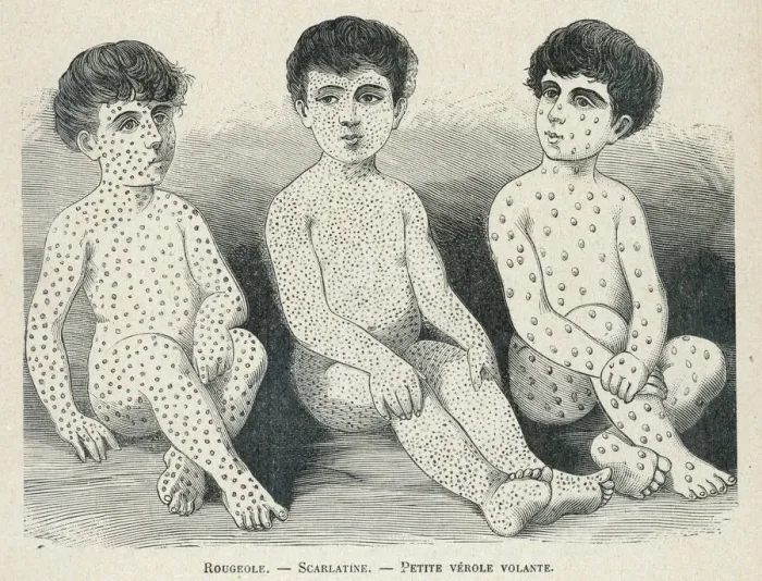 Framed Print : Measles Print Comparison Framed Print : Measles Print Comparison