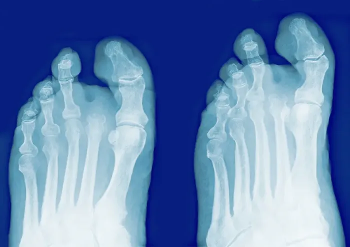 Framed Print : Amputated Toe X-ray Print Framed Print : Amputated Toe X-ray Print