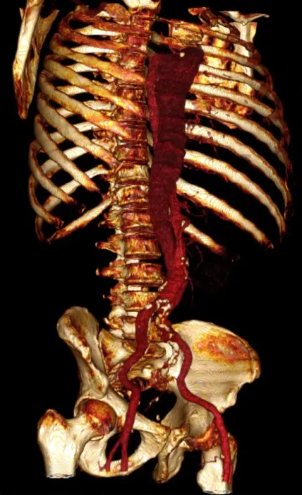 Framed Print : 3D CT Scan Print of Aortic Dissection Framed Print : 3D CT Scan Print of Aortic Dissection