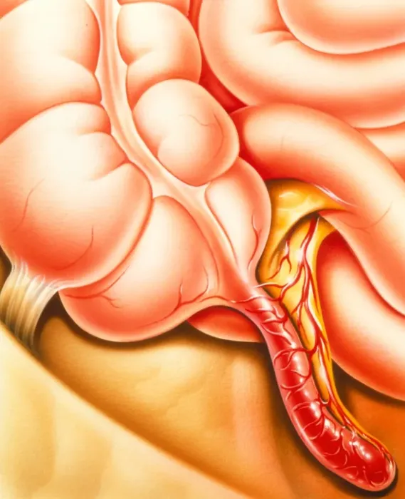 Framed Print : Appendix with inflamed appendix Print Framed Print : Appendix with inflamed appendix Print