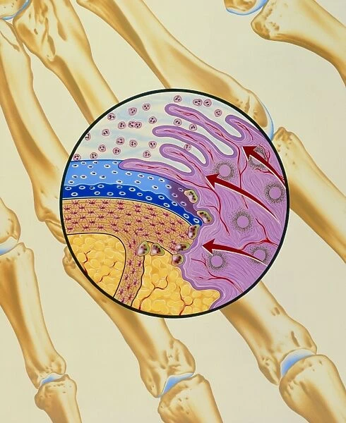 Artwork of the mechanism of rheumatoid arthritis
