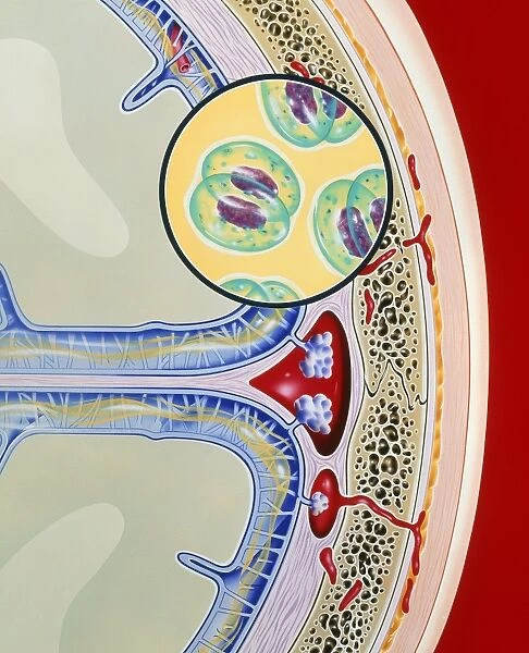 Artwork of meninges & bacteria showing meningitis Artwork of meninges & bacteria showing meningitis