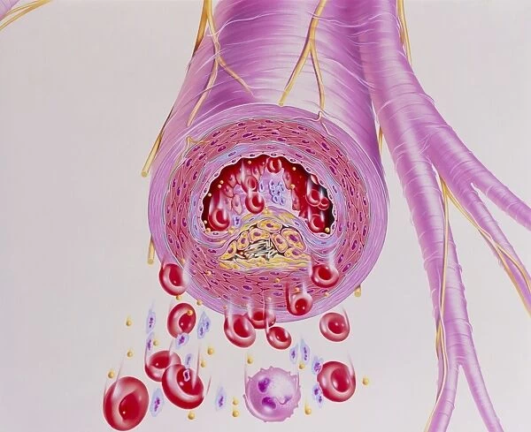 Artwork of narrowed artery by atherosclerosis