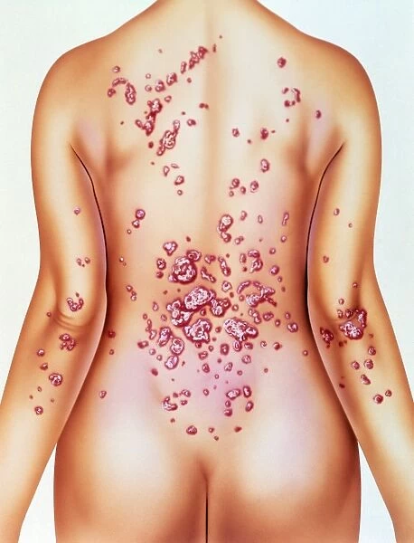 Artwork of psoriasis on womans back
