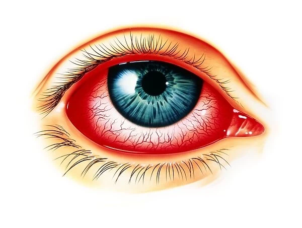 Artwork showing eye with allergic conjunctivitis