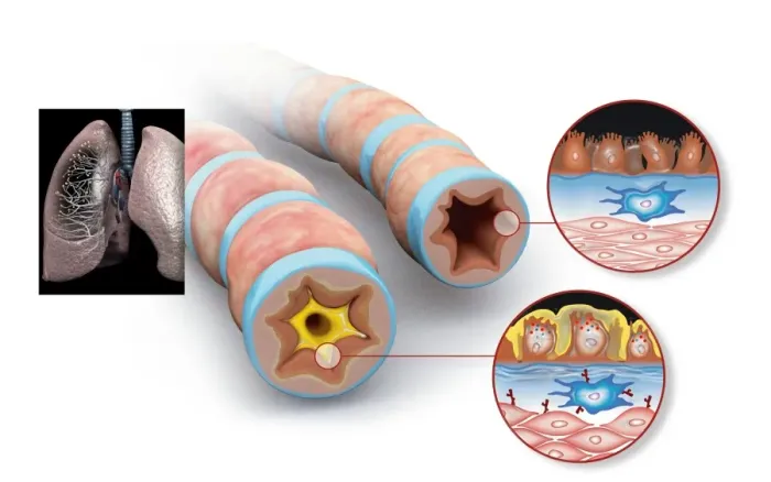 Framed Print : Asthma Pathology Print Framed Print : Asthma Pathology Print