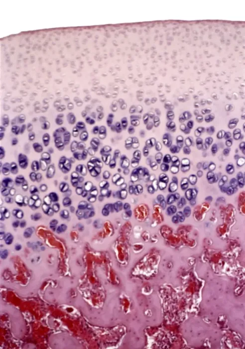 Framed Print : Bone growth, light micrograph Print Framed Print : Bone growth, light micrograph Print