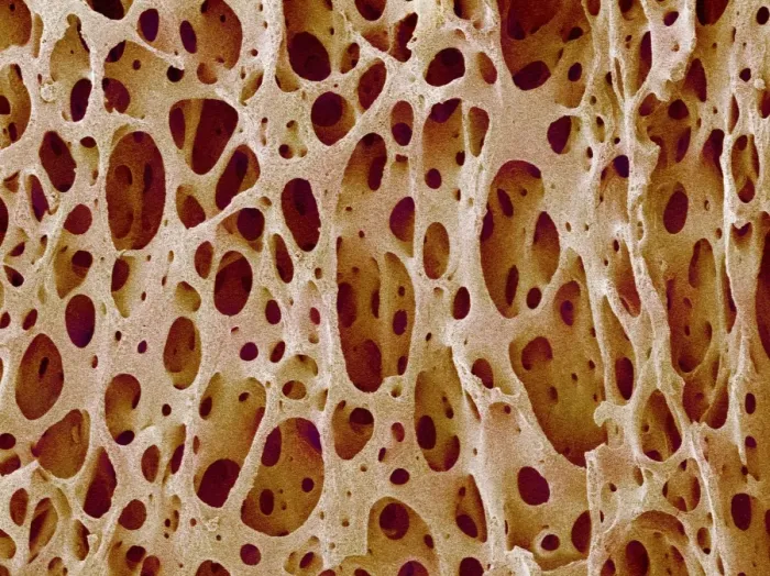 Framed Print : Cancellous Bone Tissue Print Framed Print : Cancellous Bone Tissue Print