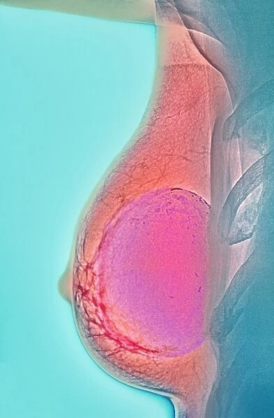 Breast implant calcification, X-ray