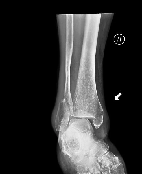 Broken ankle, X-ray C017  /  7185