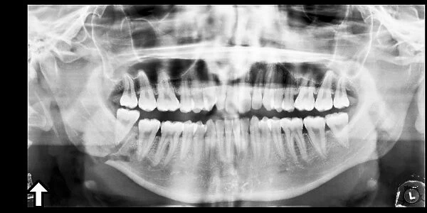 Broken jaw, X-ray C017  /  7557