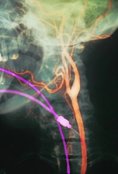 Carotid arteries, X-ray