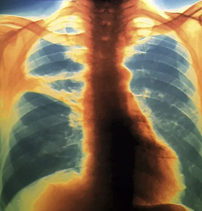 Framed Print : Colour X-ray Print of Lung Collapse Framed Print : Colour X-ray Print of Lung Collapse