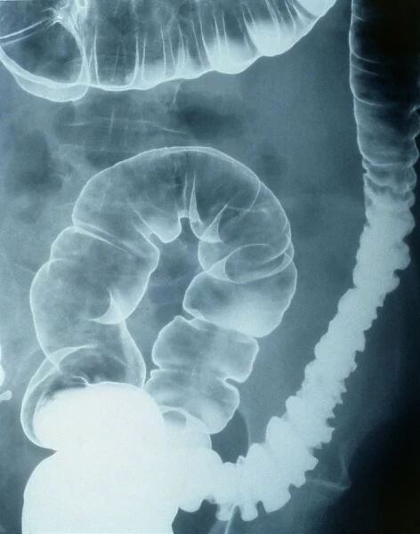 Colonic spasm, X-ray