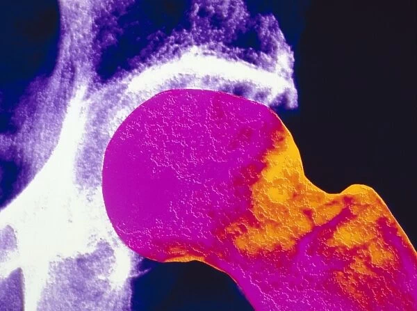 colour X-ray of upper femur with osteoporosis