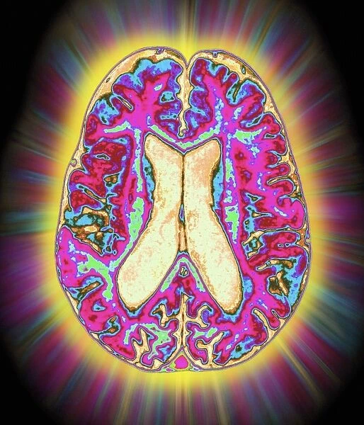 Coloured MRI scan of organophosphate brain damage
