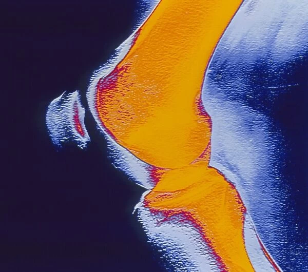 Coloured X-ray of a human knee joint (side view)