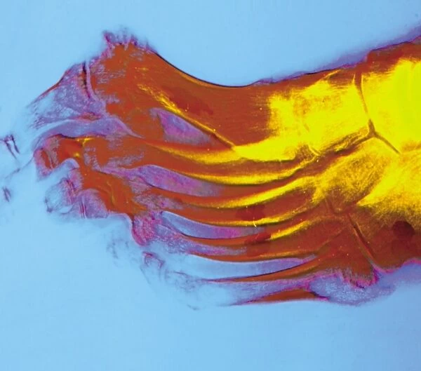 Coloured X-ray of rheumatoid arthritis of a foot