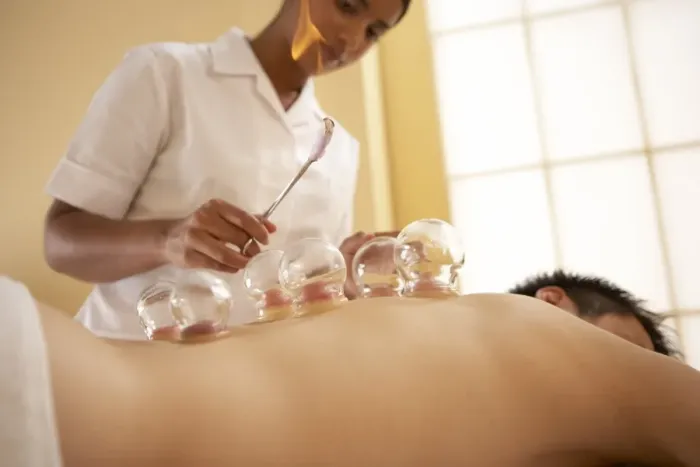 Framed Print : Cupping Therapy Print: A Client's Back with Heated Cups Framed Print : Cupping Therapy Print: A Client's Back with Heated Cups
