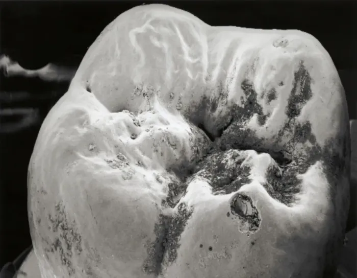 Framed Print : SEM Print of Decaying Molar Tooth Framed Print : SEM Print of Decaying Molar Tooth