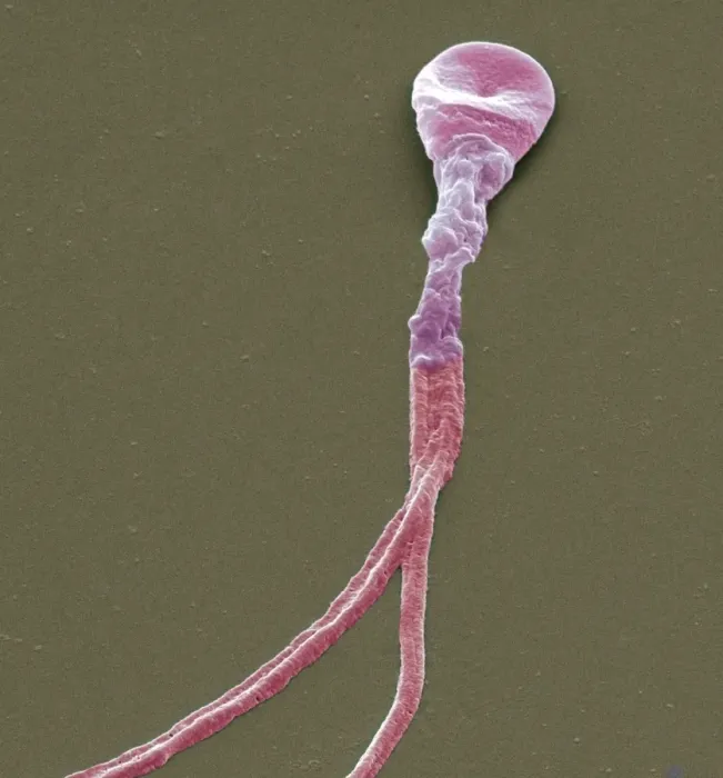 Framed Print : Deformed sperm cell Print, SEM image Framed Print : Deformed sperm cell Print, SEM image