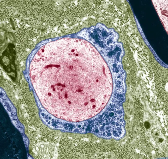 Framed Print : Demyelinated nerve Print, TEM Framed Print : Demyelinated nerve Print, TEM