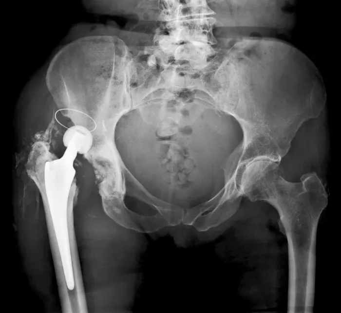 Framed Print : Dislocated Hip Replacement Print