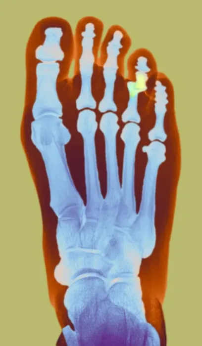 Framed Print : Dislocated Toe X-ray Print Framed Print : Dislocated Toe X-ray Print
