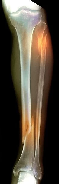 Double fracture to the leg, X-ray