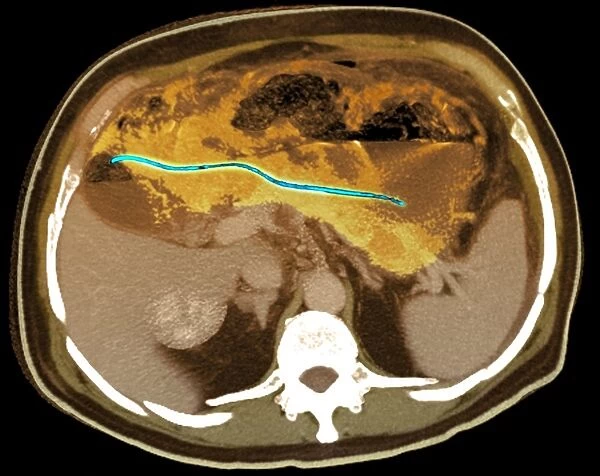 Ectopic pancreatic stent, CT scan
