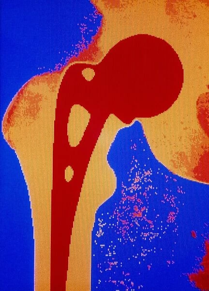 False colour x-ray of prosthetic hip joint