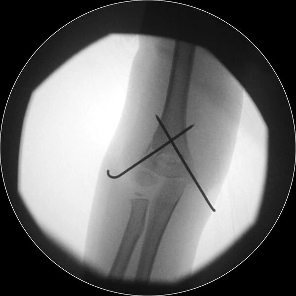 Fixed arm fracture, X-ray C017  /  7265
