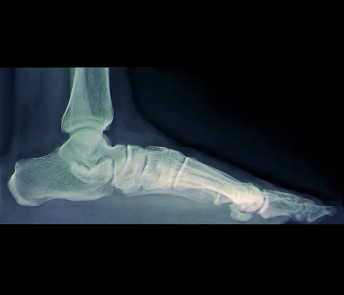 Framed Print : Flat Foot, X-ray Coloured Print (Side View) Framed Print : Flat Foot, X-ray Coloured Print (Side View)