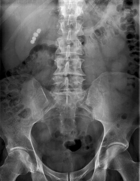 Gallstones, X-ray C017  /  7860