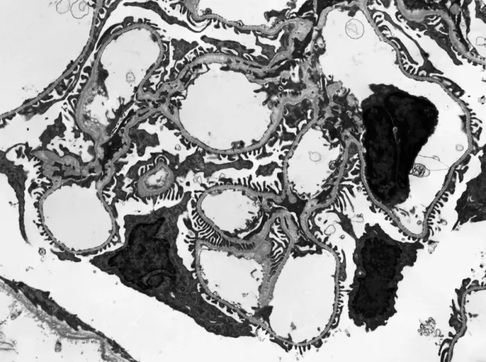 Framed Print : TEM Print of Glomerulus in Human Kidney Framed Print : TEM Print of Glomerulus in Human Kidney