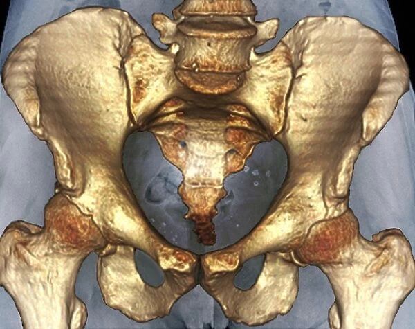 Healthy pelvis, 3D CT scan