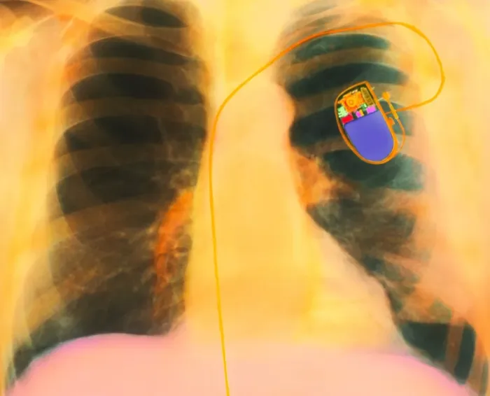 Framed Print : Coloured X-ray Print of a Fitted Heart Pacemaker Framed Print : Coloured X-ray Print of a Fitted Heart Pacemaker