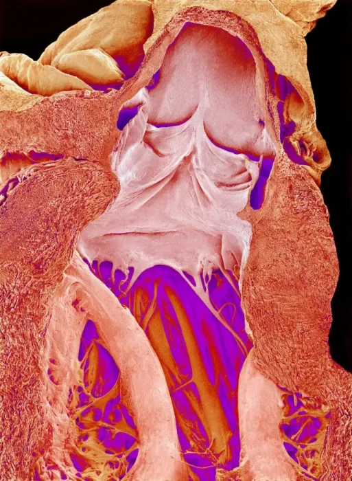 Framed Print : Coloured SEM Print of Heart Valves and Strings Framed Print : Coloured SEM Print of Heart Valves and Strings
