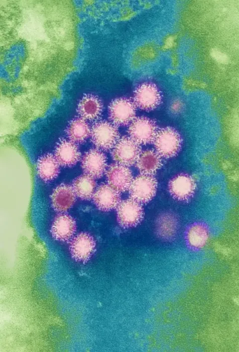 Framed Print : Hepatitis B Virus Print: Coloured TEM Image Framed Print : Hepatitis B Virus Print: Coloured TEM Image