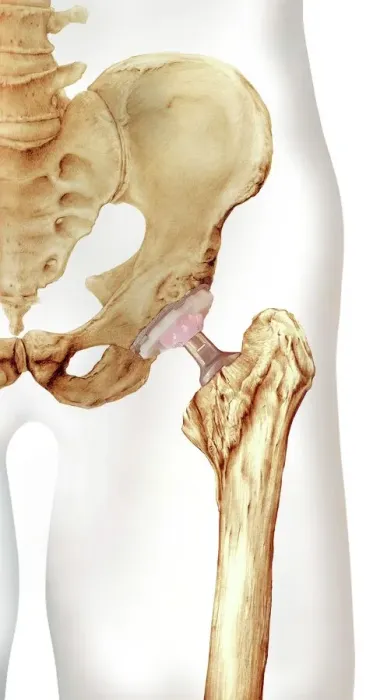 Framed Print : Hip Replacement Print: A Prosthetic Joint
