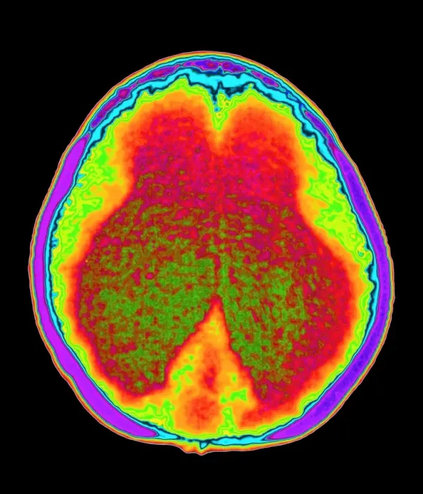 Framed Print : Hydrocephalus CT Scan Print Framed Print : Hydrocephalus CT Scan Print