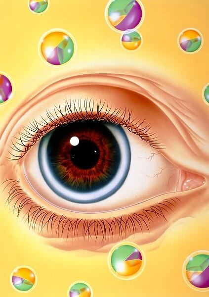 Illustration of arcus senilis condition of the eye