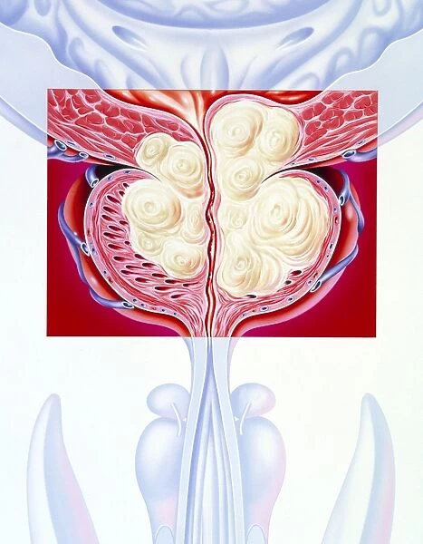 Illustration of a benign prostatic hyperplasia