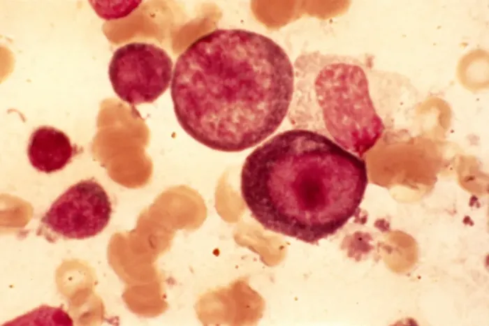 Framed Print : Infectious Mononucleosis Print, Light Micrograph of Blood Cells Framed Print : Infectious Mononucleosis Print, Light Micrograph of Blood Cells