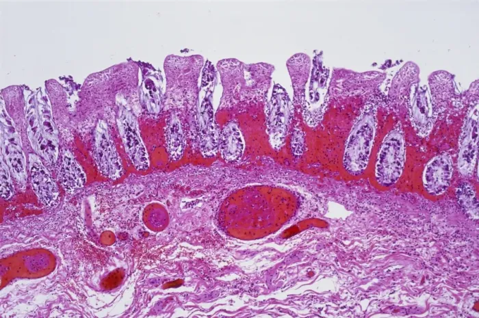Framed Print : Ischaemic bowel print, x20 magnification Framed Print : Ischaemic bowel print, x20 magnification