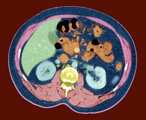 Kidneys, abdominal CT scan