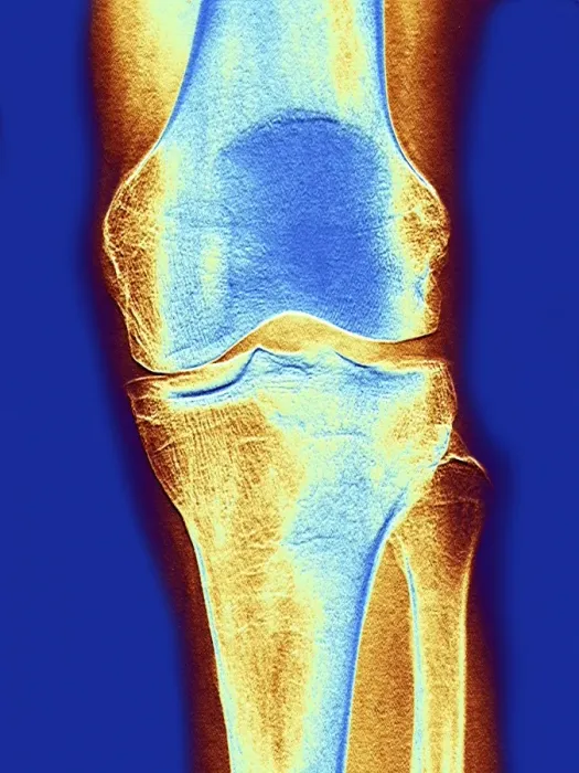 Framed Print : Colour X-ray Print of the Knee Joint Framed Print : Colour X-ray Print of the Knee Joint