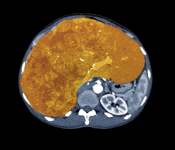 Liver cancer, CT scan C018  /  0461
