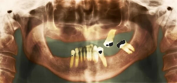 Loss of teeth, X-ray